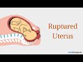 Causes and Treatment of Ruptured Uterus