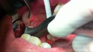 LASER BIOPSY_CHEEK FIBROMA-Dr. Stephen R. John