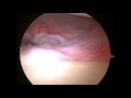 Arthroscopic capsular release for adhesive capsulitis of the shoulder