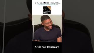 Afro hair transplant via FUE method