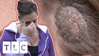 Wart On Debra's Head Wont Stop Growing! | Dr. Pimple Popper