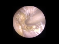 ear wax removal endoscopic clearwax ear wax removal specialists