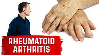 Use These Spices and Herbs for Rheumatoid Arthritis – Remedies for Rheumatoid Arthritis – Dr.Berg