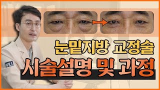 눈밑지방 교정술 프로세스