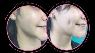 How to Get Dimples, Get Dimples Surgery