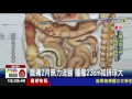 40年來天天醉男罹患霸王級肝癌腫瘤