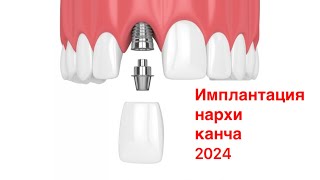 Имплантация нархи канча 2024. Тел +998911777720