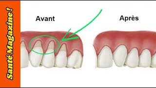 3 remèdes naturels pour réparer les gencives qui se rétractent !