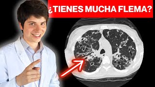 TODO sobre BRONQUIECTASIAS ► FISIOPATOLOGÍA y SÍNTOMAS en 11 MINUTOS [MÍRALO] 😉