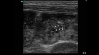 Intestinal Ascariasis Video 1 from Kessler et al