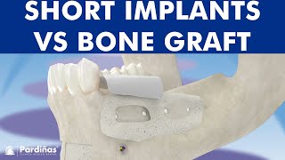 Short implants and bone augmentation ©