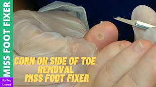 Corn on side of toe removal | Miss Foot Fixer