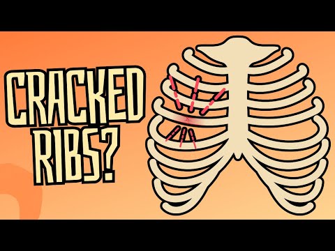 Cracked & Broken Ribs: Symptoms, Treatment, & Recovery Time. Cracked & Broken Ribs: Symptoms, Treatment, & Recovery Time.