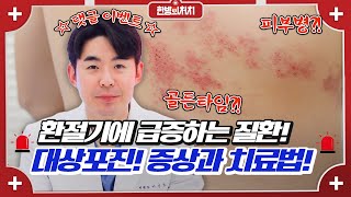 🎊이벤트🎊 바늘로 찌르는 고통?!😨 통증의 왕 대상포진의 모든 것! [한방의처치]