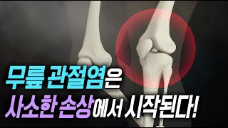 명의 헬스케어 - 무릎 관절염은 사소한 손상에서 시작된다!