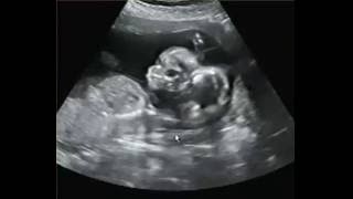 TWINS gender 16 weeks 3D/4D Ultrasound!! A New Conception 3d Ultrasound Studio