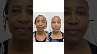 24 Hours After A Facelift Insane Results Plasticsurgery