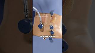 Robot-Assisted Human Kidney Removal (3D Animation)