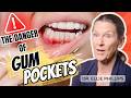 Heal Gum Pockets & Eliminate Deep Cleanings