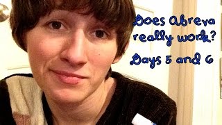 Does Abreva Really Work? -- DAYS FIVE AND SIX