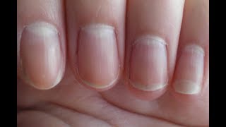 Know Your Nails Tell About Your Body Condition.