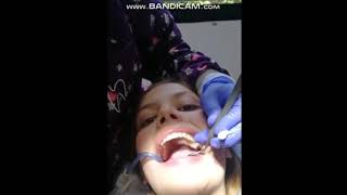 Teen girl getting filled with amalgams (Deep drilling)