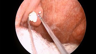 Tonsil stone removal. 편도 결석 제거