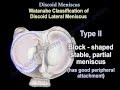 Discoid Meniscus - Everything You Need To Know - Dr. Nabil Ebraheim