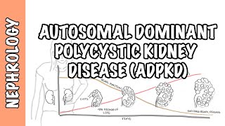 Autosomal Dominant Polycystic Kidney Disease (ADPKD) - causes, pathophysiology, diagnosis, treatment