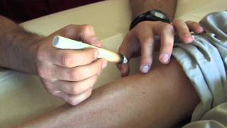 Chinese medicine: Moxibustion