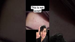 Derm explains what’s actually causing your forehead acne #acnetreatment #acnecauses #fungalacne