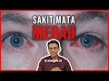 Punca dan Rawatan Sakit Mata Merah (Acute Conjunctivitis). Tips dan Cara Pakai Ubat Titis Mata.