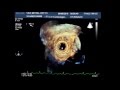 Apical Edwards SAPIEN 3 Transcatheter Mitral Valve Replacement