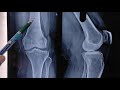 How To Read Knee Joint X Ray ..Dr Sai Chandra MBBS DNB (Ortho)