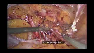 laparoscopic TAPP PLUS (meshless)for an obstructed gangrenous inguinofemoral hernia in a female