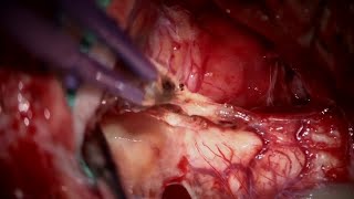 Resection of Right Lateral Medullary Hemangioblastoma