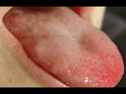 How to Heal a Burnt Tongue How to Heal a Burnt Tongue