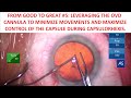 From Good to Great #5: Leverage OVD Cannula to Minimize Steps& Maximize Control for Capsulorhexis.