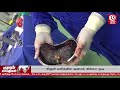 சிறுமி வயிற்றில் அரைக் கிலோ முடி டாக்டர்கள் அதிர்ச்சி covai moon tv news