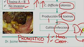 Gastroenterología - Colitis Pseudomembranosa   Enf  Celiaca