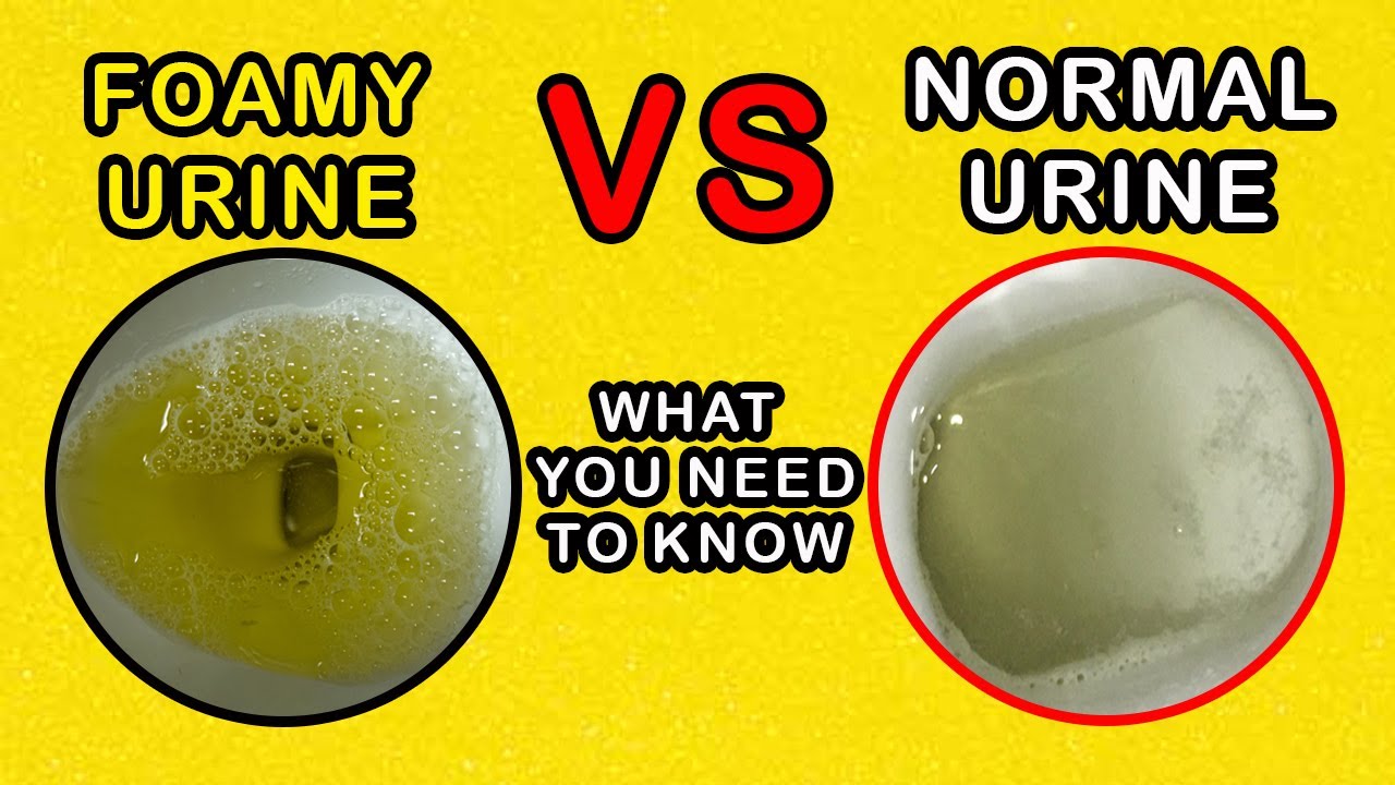 Foamy Urine Vs Normal Urine: What Is The Difference And Causes - YouTube