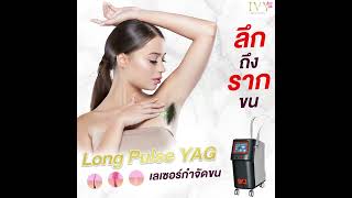 รักแร้เนียนไร้ที่ติด้วย  Long Pulse YAG