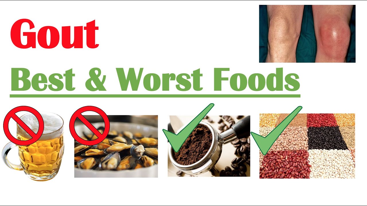 Best & Worst Foods To Eat With Gout | Reduce Risk Of Gout Attacks And ...