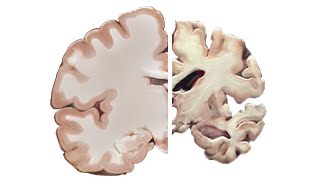 Alzheimer's and the Brain