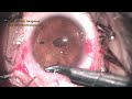 A new capsular bag sparing technique for Microspherophakia & zonulopathies  with Iris clip IOL