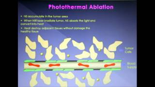 Intratumoral administration of gold nanoshells - Video abstract: 30699