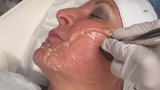 Forma Facial Skin Tightening at MD Beauty Clinic