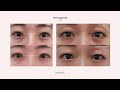 miyoungs antiaging method for eyes thermage flx help you achieve younger looking eyes