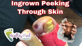 Worst Ingrown of the Year, Ingrown Toenail, Infected Ingrown Nail , Ingrown Toenail Removal