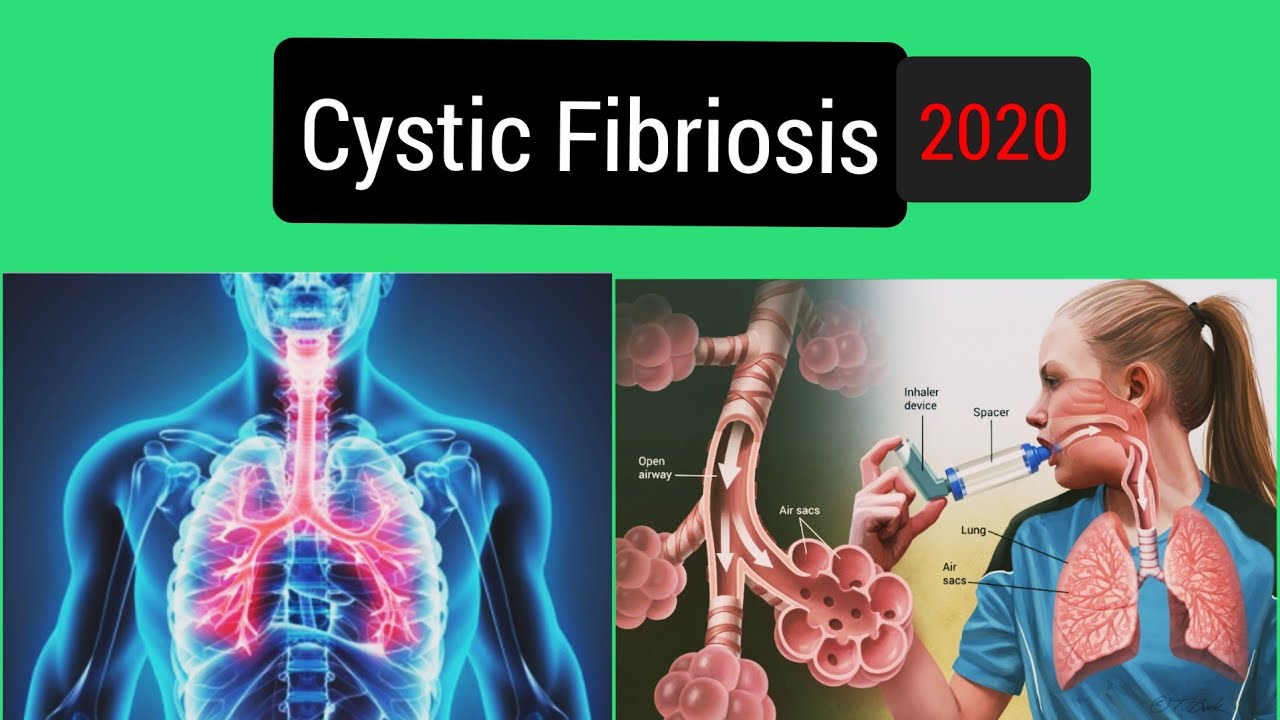 Pathophysiology Of Cystic Fibrosis